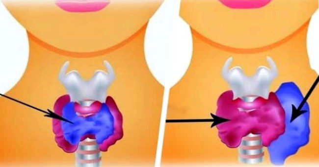 hyperthyroidism-hypothyroidism